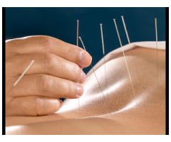 Acupuncture Etobicoke